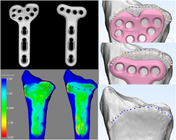 Bone and Plate Models