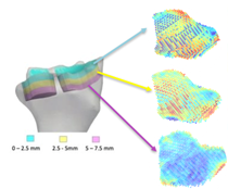 subchondral.png